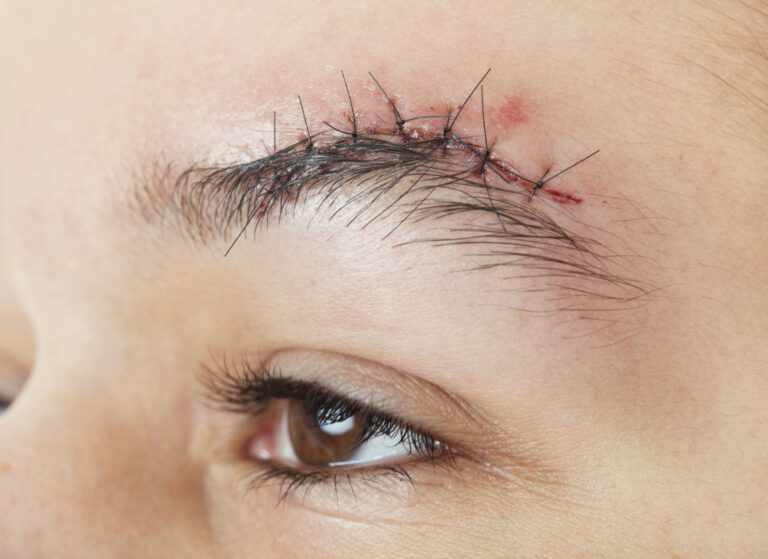 A woman is suffering caused by a laceration to her eyebrow