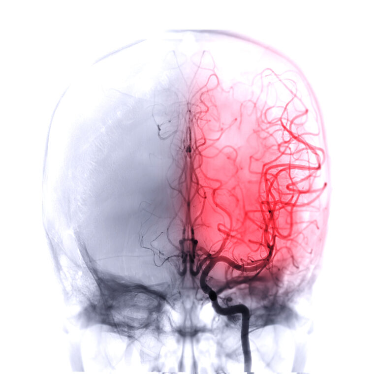 A brain scan where the left side of the brain is highlighted in red to indicate brain damage from a stroke misdiagnosis.