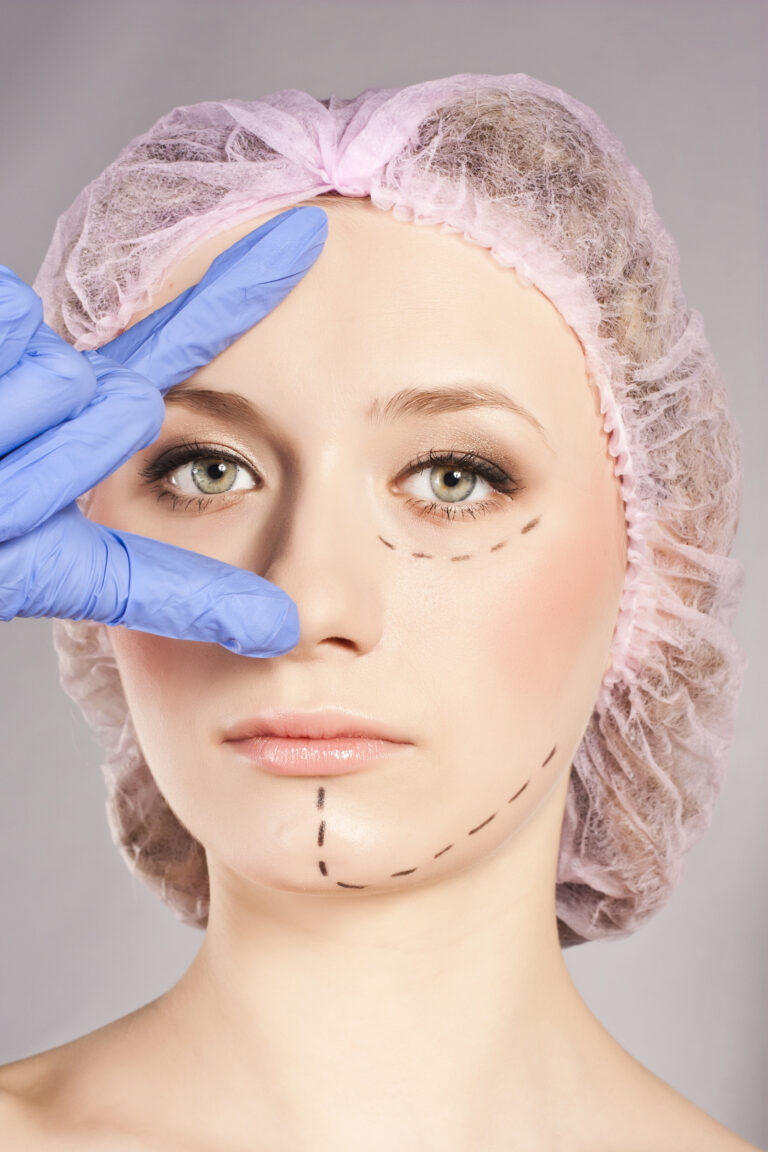A woman with lines drawn on her face before receiving corrective surgery on her face